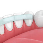 3d render of  teeth with dental reinforcement fiber over white